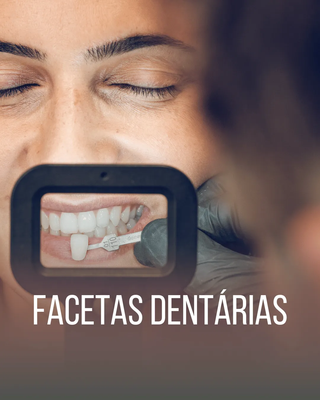 Sorriso branco, alinhado e harmônico.